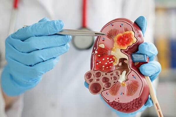 nefrologista Quando procurar um nefrologista