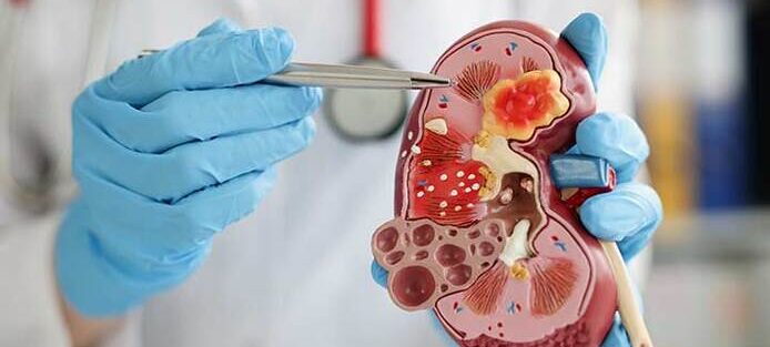 Quando procurar um nefrologista